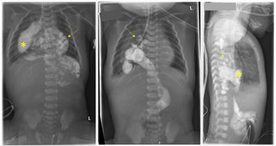 Case Report: A “senior” with serpentine-like syndrome—treatment of combined brachyoesophagus, intrathoracic stomach and cervical rachischisis